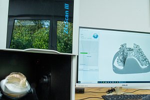 individuelles Abutment (Stützpfeiler) für das Zahnfleisch-Gingiva-Management Wir digitalisieren mit Hilfe von CAD-CAM
